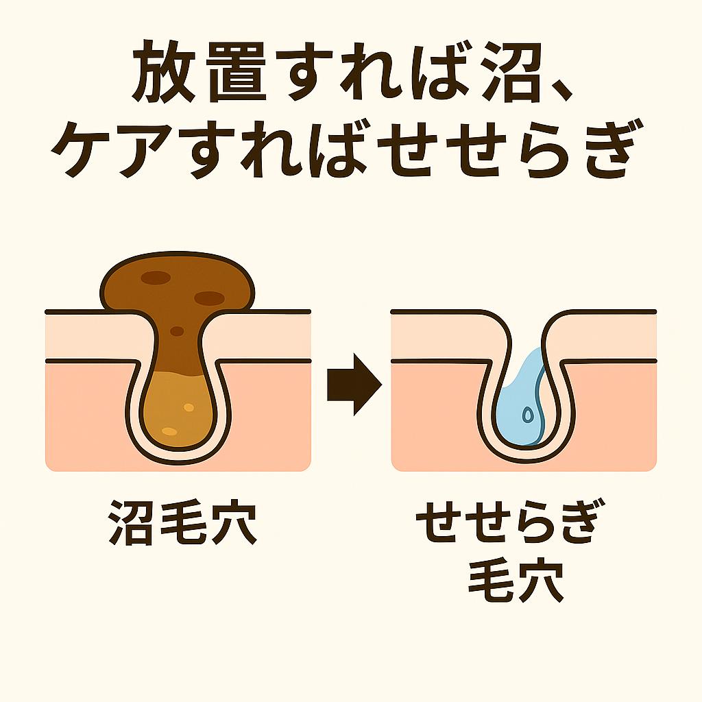図解イラスト：対比構成。左：ごわつきで皮脂が溜まり茶色く濁った“沼毛穴”。右：ケアによって皮脂が青い水流のように流れている“せせらぎ毛穴”。上部にはキャッチコピー『放置すれば沼、ケアすればせせらぎ』と書かれている。