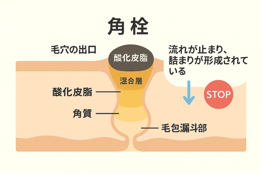 毛穴の断面構造図。「角栓」の3層構造が視覚化されており、上層に「酸化皮脂」（黒色）、中層に「混合層」（黄褐色）、下層に「角質」（ベージュ）が表示されている。毛穴出口と毛包漏斗部の構造が描かれ、右側には「流れが止まり、詰まりが形成されている」という注釈とSTOPマークが示されている。