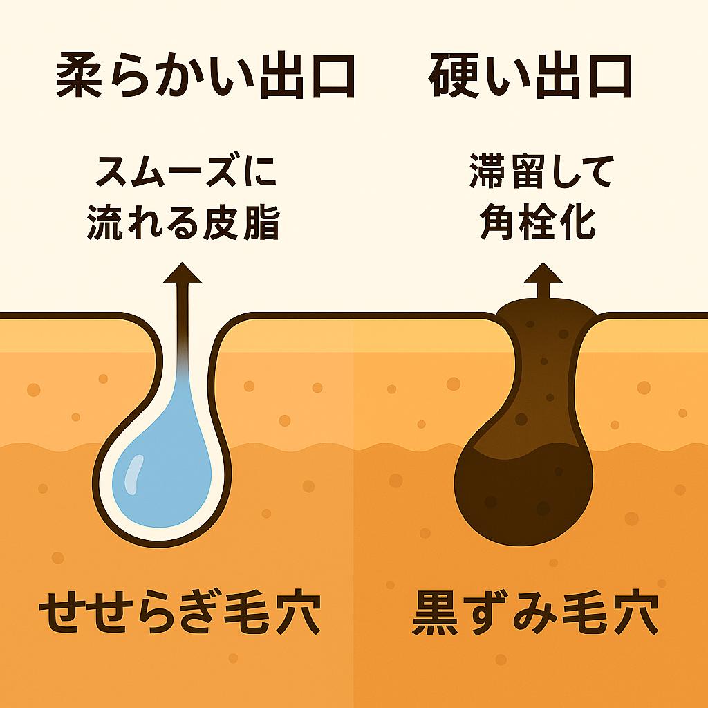 左右比較の毛穴イラスト。左は「柔らかい出口」で皮脂がスムーズに流れ「せせらぎ毛穴」と表現されている。右は「硬い出口」で皮脂が滞留し角栓化し「黒ずみ毛穴」と表現されている。出口の状態が詰まりやすさを左右することを示す図。