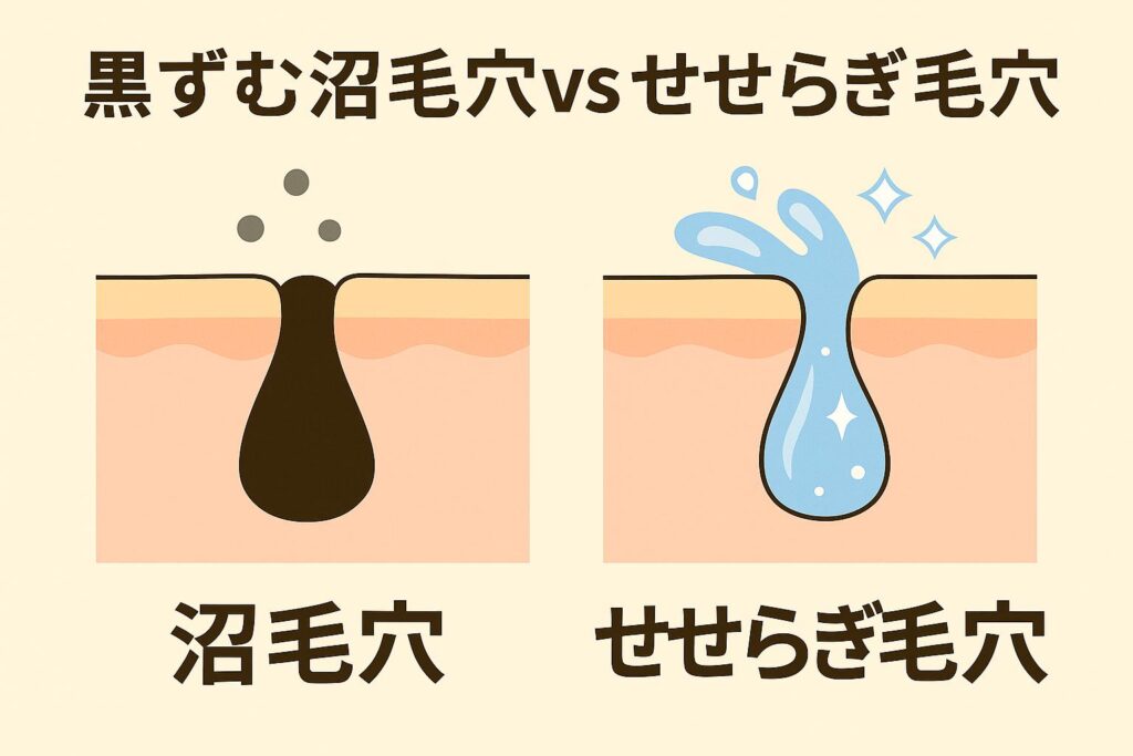 アニメ調の対比イラスト。左は黒ずんだ角栓で詰まった「沼毛穴」が描かれ、皮脂が滞留している様子。右は水が流れるように澄んだ「せせらぎ毛穴」が描かれ、皮脂がスムーズに排出されている。上部には「黒ずむ沼毛穴 vs せせらぎ毛穴」とタイトルが表示され、両者の違いを視覚的に強調している。