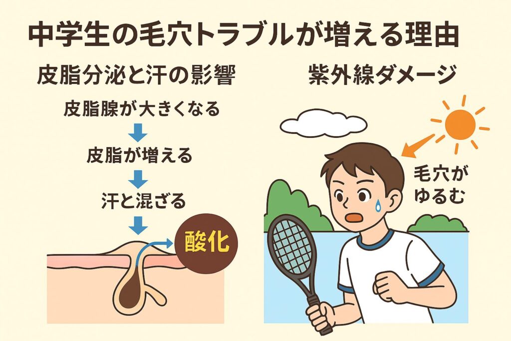 「中学生の毛穴トラブルが増える理由」というタイトルの図解。左側は皮脂腺が大きくなり、皮脂が増えて汗と混ざり、酸化するまでの流れを矢印で示した毛穴断面図。右側はテニスをする男子中学生に太陽の紫外線が当たり、「毛穴がゆるむ」と説明されたイラスト。