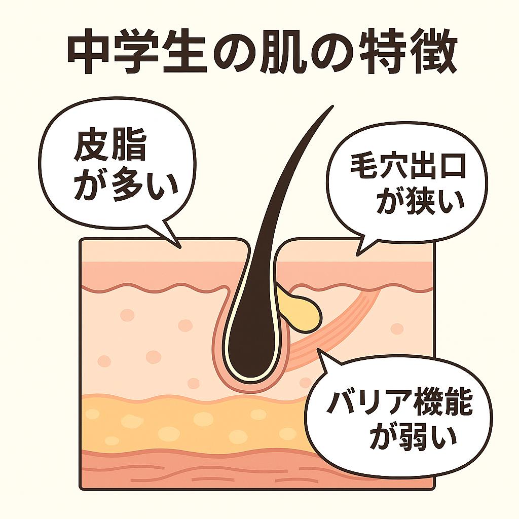 中学生の肌の断面イラスト。
毛穴の周囲を示しながら、吹き出しで「皮脂が多い」「毛穴出口が狭い」「バリア機能が弱い」と説明しており、思春期特有の肌状態をわかりやすく示している。