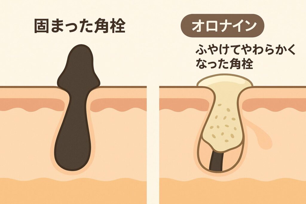「毛穴の断面図イラスト。左は黒く固まった角栓が毛穴に詰まっている様子で『固まった角栓』と記載。右はオロナインでふやけて柔らかくなった角栓が描かれ、『オロナイン ふやけてやわらかくなった角栓』と記載されている。」