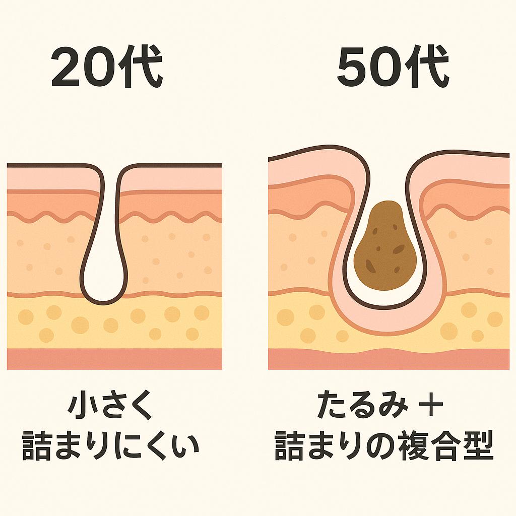 「20代と50代の毛穴構造比較図。20代は小さく詰まりにくい毛穴、50代はたるみと詰まりが重なった複合型毛穴として描かれている断面イラスト。」