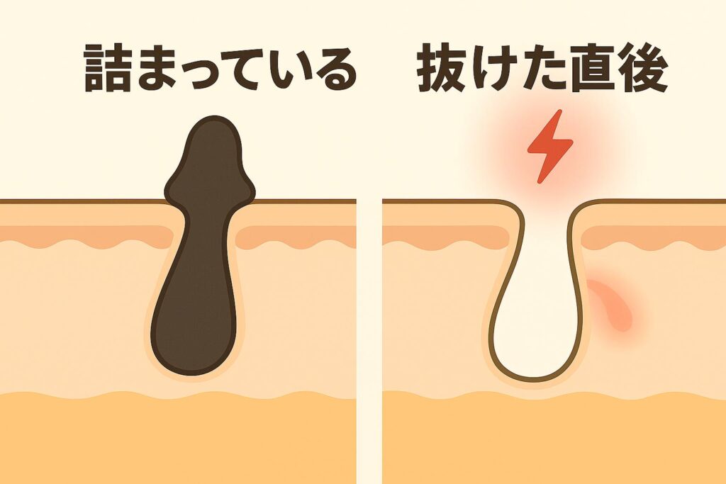「毛穴の断面図イラスト。左は黒い角栓で詰まっている状態。右は角栓を抜いた直後の空っぽの毛穴で、赤い稲妻マークと赤みが描かれ、炎症リスクを示している。」