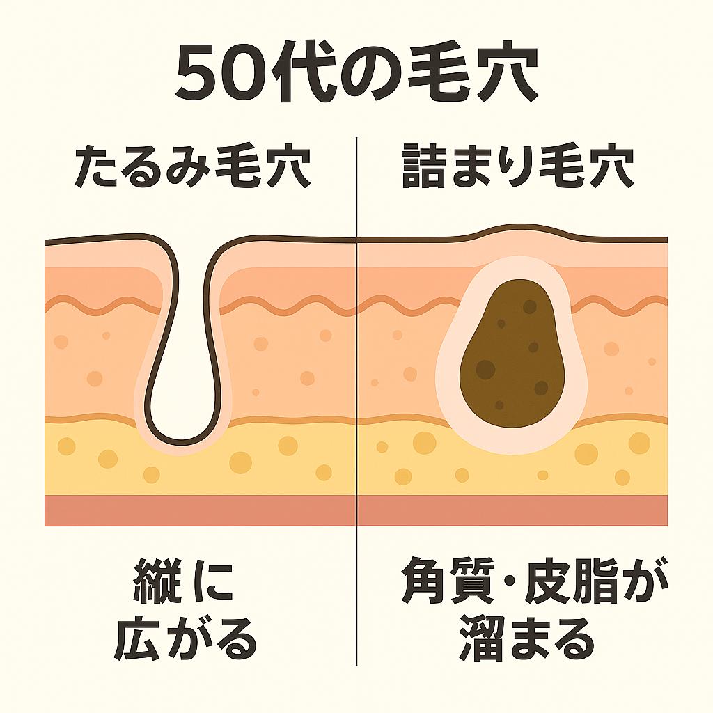 「50代の毛穴ダブルトラブル図解。左側は縦に広がるたるみ毛穴、右側は角質と皮脂が溜まる詰まり毛穴を断面図で示している。」