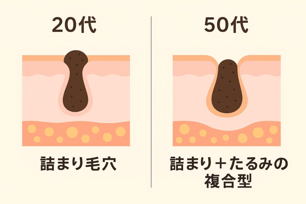 「20代の詰まり毛穴」と「50代の詰まり+たるみの複合型毛穴」を比較した毛穴断面図のイラスト。左は単純な角栓による詰まり毛穴、右は角栓に加えて毛穴の縁が下に引っ張られ広がった複合型毛穴を表現。