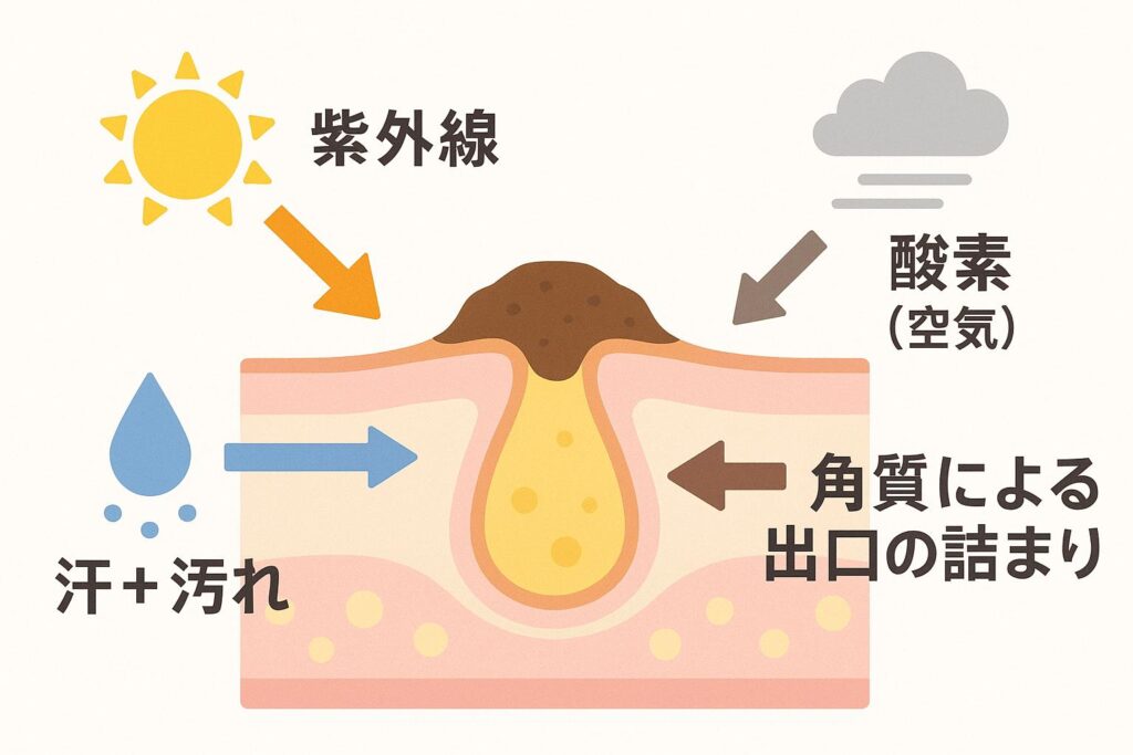 「毛穴断面図を中心に、酸化要因を示すイラスト。
左上から紫外線☀️、右上から酸素（空気）💨、左から汗＋汚れ💦、右から角質による出口の詰まり🧱が矢印で毛穴に向かって描かれている。毛穴内部には皮脂がたまり、出口が塞がれている様子。」