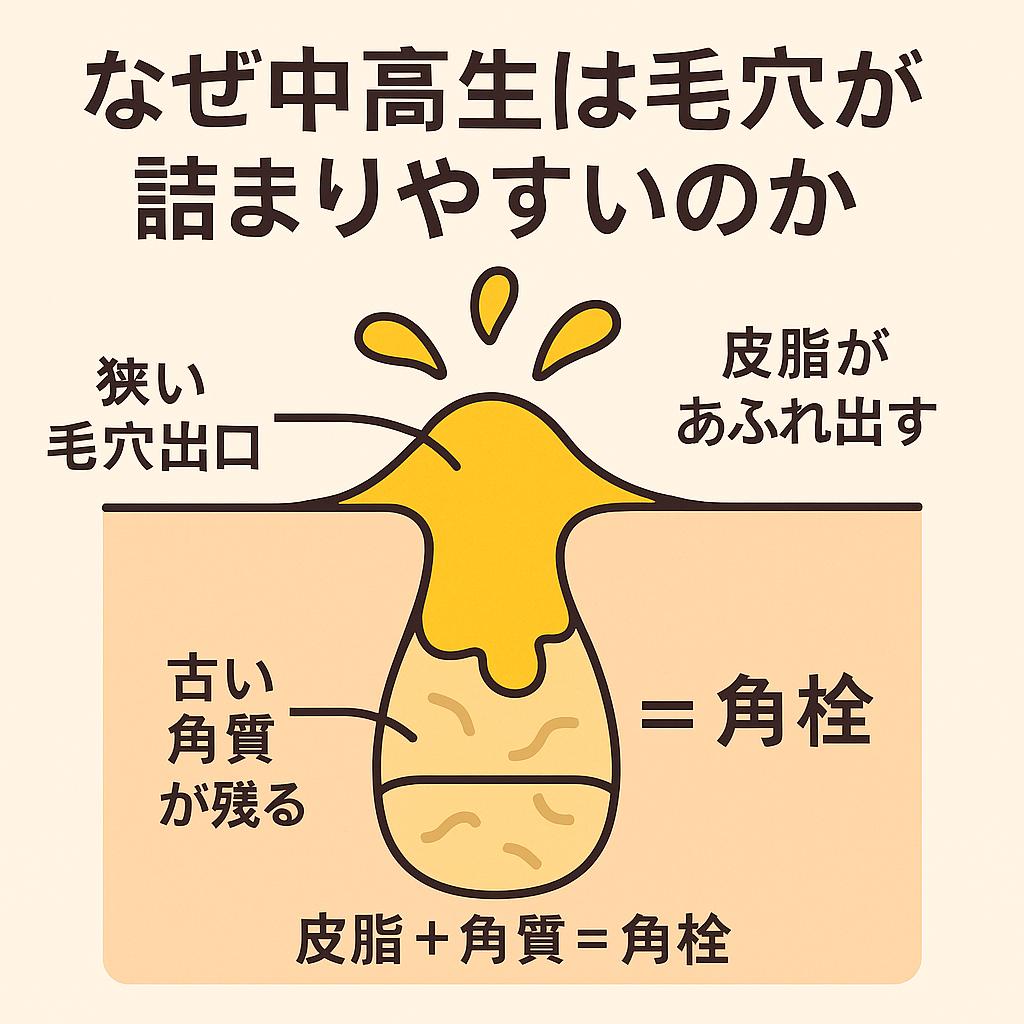 「なぜ中高生は毛穴が詰まりやすいのか」という見出し付きの教育的イラスト。
毛穴断面図が描かれ、以下のラベルが付いている：

狭い毛穴出口

皮脂があふれ出す

古い角質が残る
中央には「皮脂＋角質＝角栓」と表示され、思春期特有の毛穴詰まりの仕組みをわかりやすく解説している。 