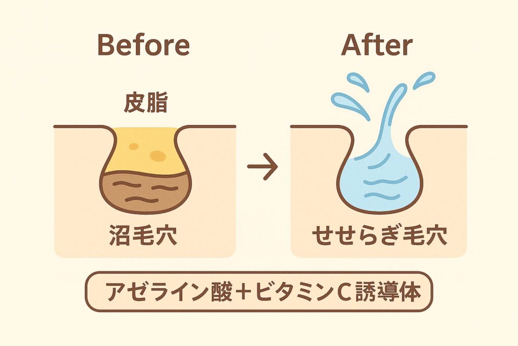 「アゼライン酸＋ビタミンC誘導体」の効果を示すビフォーアフター図。左側（Before）は皮脂が詰まり濁った「沼毛穴」として描かれ、右側（After）は水の流れがスムーズな「せせらぎ毛穴」として表現。中央に矢印で変化を示し、下部には成分名ラベルが配置されている。ベージュ背景のフラットデザイン。