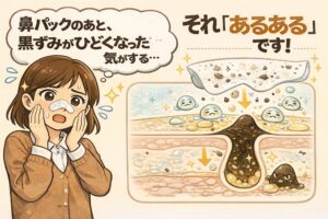鼻パック後に黒ずみがひどくなったように感じる「あるある」現象を解説した図解イラスト。鼻パックを外した女性の不安な表情と、毛穴断面図で角栓が引き抜かれた後に皮脂や汚れが再び溜まり、黒ずみが目立ちやすくなる構造を示している。