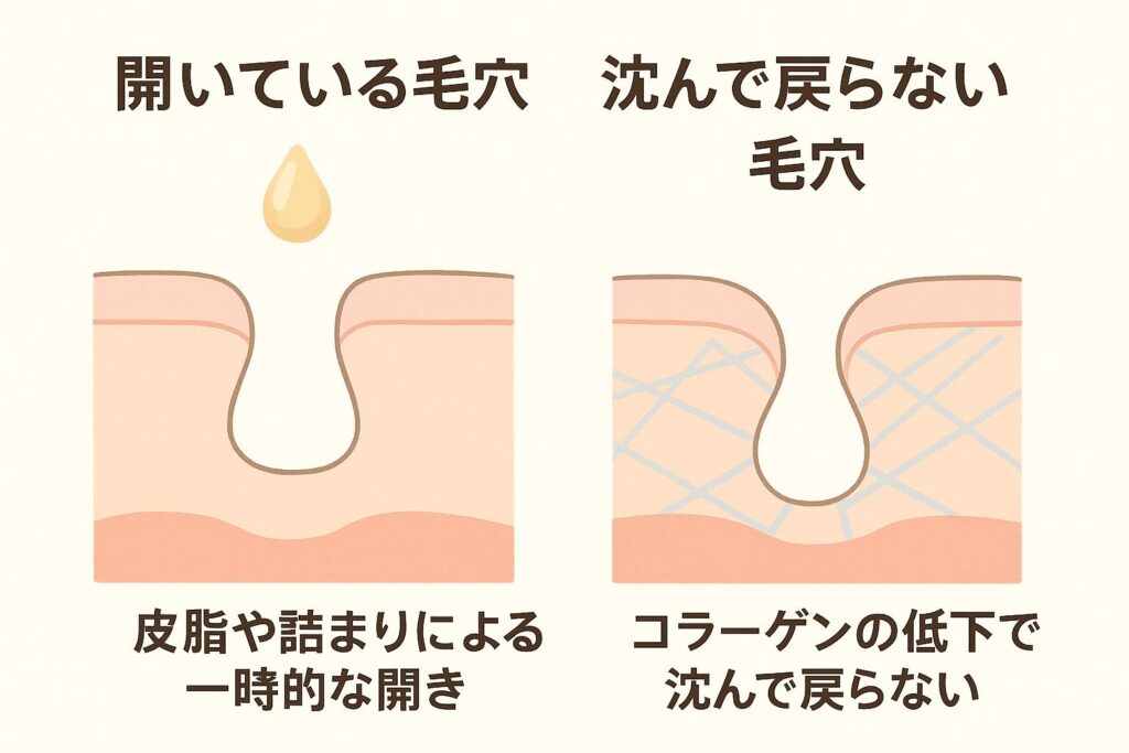「左に“皮脂や詰まりによる一時的な開き毛穴”、右に“コラーゲンの低下で沈んで戻らない毛穴”を示した断面図イラスト。開き毛穴は表面が広がり皮脂が溜まっている様子、沈む毛穴は真皮のコラーゲンネットが弱まり縦に沈み込んでいる様子が描かれている。」