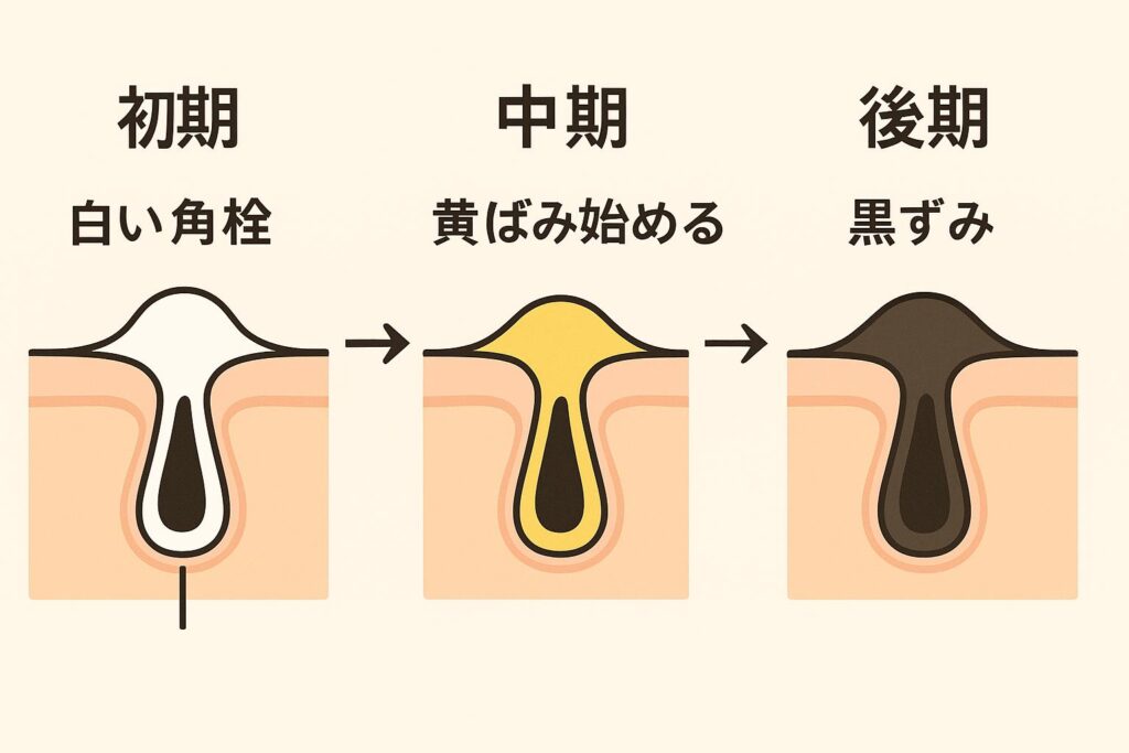 「角栓の成長ステップを示す図解。
左:初期(白い角栓)、中央:中期(黄ばみ始める)、右:後期(黒ずみ)。
毛穴断面イラストで、角栓が白から黄、黒へと酸化し進行する様子を表現。」