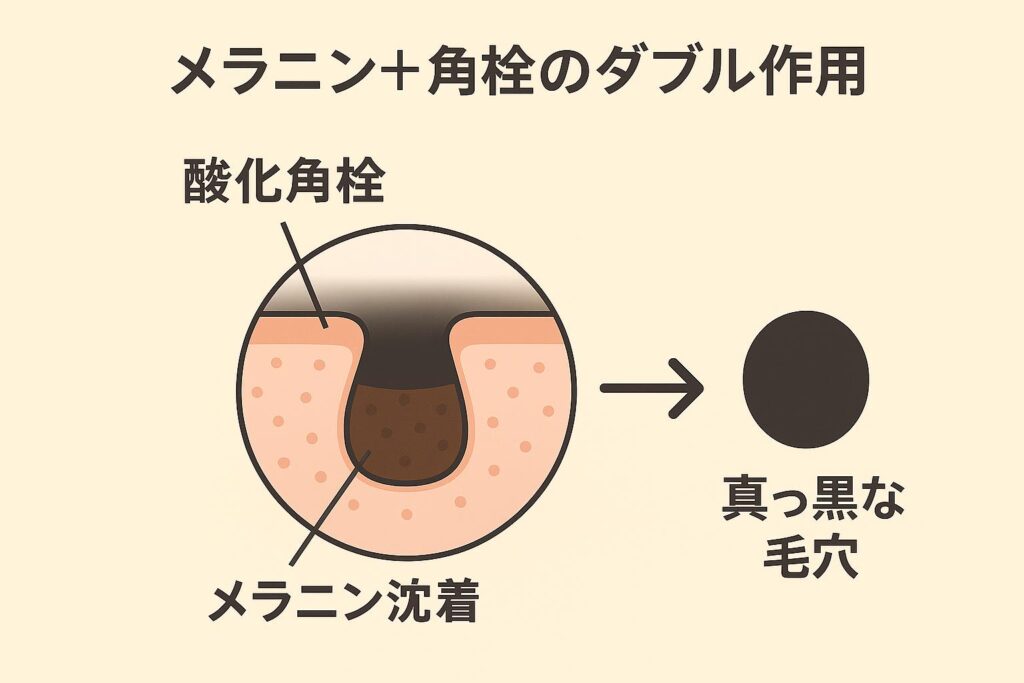 毛穴断面の図解。毛穴の出口に「酸化角栓」、縁に「メラニン沈着」が重なり、矢印の先で「真っ黒な毛穴」として表現されている。角栓酸化とメラニン沈着のダブル作用で黒ずみが強調される仕組みを示すイラスト。