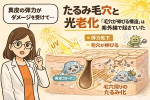 たるみ毛穴の原因が紫外線による光老化であることを解説した図解イラスト。UVダメージによって真皮のコラーゲンや弾力が低下し、毛穴周囲の皮膚がたるんで毛穴が縦に伸びて見える仕組みを、毛穴断面と擬人化キャラクターで表現している。白衣の専門家が説明し、弾力低下・毛穴拡大・たるみの関係を視覚的に示している。