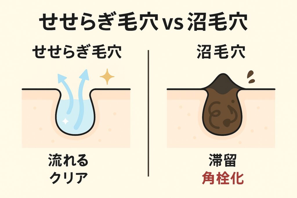 「せせらぎ毛穴 vs 沼毛穴」を比較した図解。 左：せせらぎ毛穴 → 青い矢印で皮脂がスムーズに流れる様子が描かれ、「流れる・クリア」と表記。 右：沼毛穴 → 黒く濁った皮脂が毛穴に滞留し、角栓化している断面図。「滞留・角栓化」と表記。