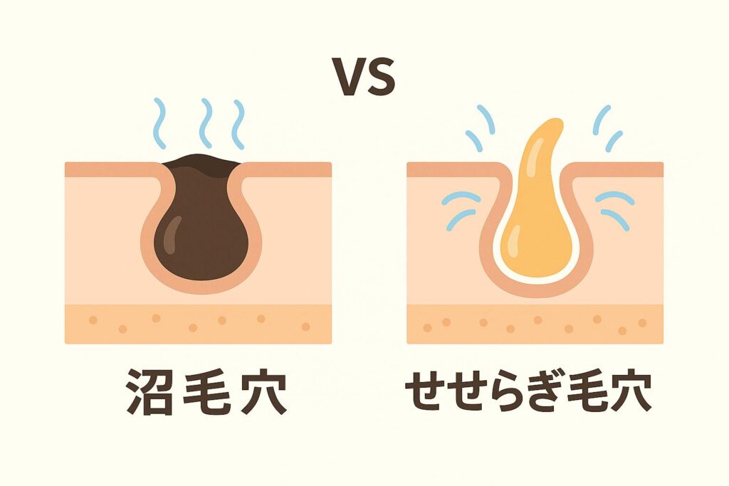 毛穴の状態を対比したイラスト。
左は「沼毛穴」で、酸化皮脂が詰まり黒くドロドロと滞留している様子。
右は「せせらぎ毛穴」で、皮脂がスムーズに流れ出し透明感のある状態。
中央に「VS」と書かれ、2つの毛穴状態の違いを強調している。