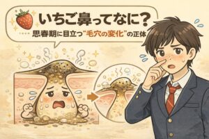 いちご鼻とは何かを、思春期に起こる毛穴の変化として解説したイラスト。皮脂分泌の増加によって毛穴に角栓が詰まり、黒ずみが目立つ仕組みを毛穴断面図で表現し、鼻を気にする学生の姿とともに視覚的に説明している。