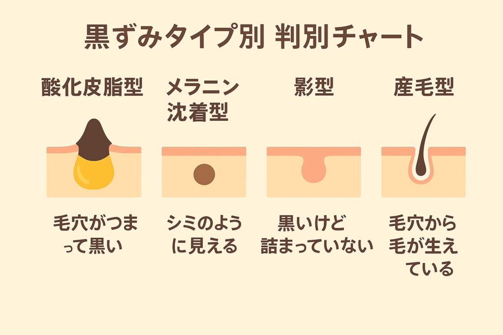 黒ずみタイプ別 判別チャートを示す横長フラットイラスト。酸化皮脂型（毛穴がつまって黒い）、メラニン沈着型（シミのように見える）、影型（黒いけど詰まっていない）、産毛型（毛穴から毛が生えている）の4タイプを毛穴断面図と簡単な説明で表示。背景は淡いベージュ。