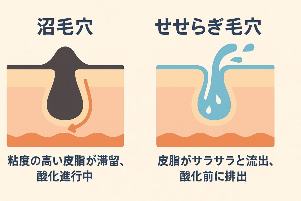 沼毛穴とせせらぎ毛穴を横長フラットイラストで比較。左の沼毛穴は皮脂が詰まり酸化進行中、右のせせらぎ毛穴は皮脂がスムーズに流れ酸化前に排出。青い水の流れとオレンジの皮脂滞留を対比。背景は淡いベージュ。