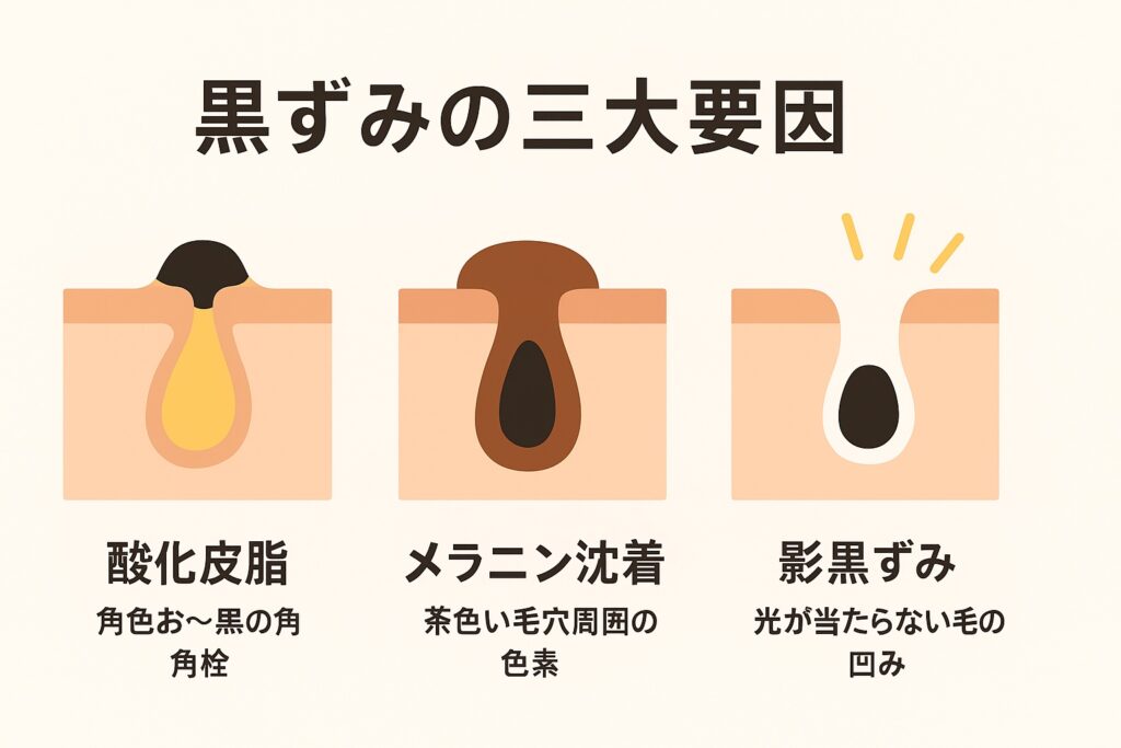 黒ずみの三大要因を示す横長フラットイラスト。酸化皮脂(黄色〜黒の角栓)、メラニン沈着(茶色い毛穴周囲の色素)、影黒ずみ(光が当たらない毛穴の凹み)を毛穴断面図と短い説明で並べた図。背景は淡いベージュ。