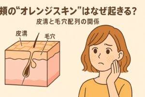 頬に現れる“オレンジスキン”の原因を解説するイラスト。左側には皮膚の断面図が描かれ、「皮溝」と「毛穴」の位置関係が示されている。右側では黄色い服の女性が頬に手を当て、心配そうにしている。テキストには「頬の“オレンジスキン”はなぜ起きる？ 皮溝と毛穴配列の関係」と書かれている。