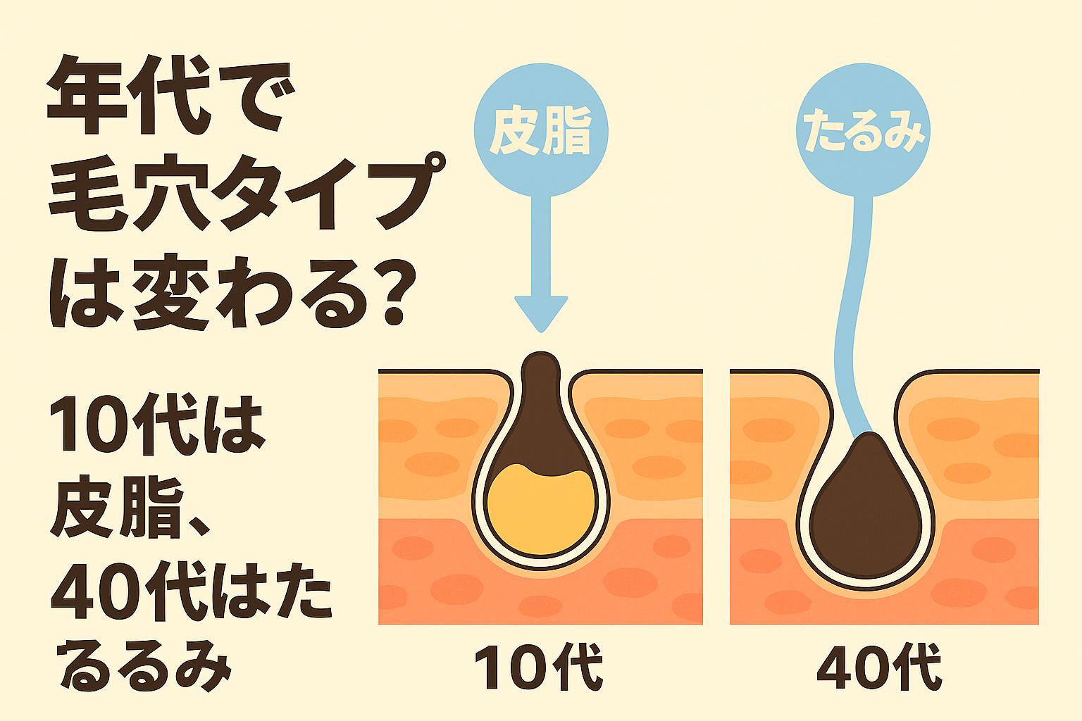 「年代で毛穴タイプは変わる?──10代は皮脂、40代はたるみ」を説明するイラスト。左側には10代の皮脂詰まり毛穴の断面図、右側には40代のたるみ毛穴の断面図が並んで描かれている。10代は皮脂分泌が多く詰まりやすい一方、40代は肌の支えが弱まり、毛穴が縦に伸びて見える“たるみ毛穴”になりやすいことを視覚的に比較した図。