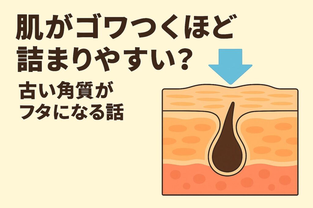 「肌がゴワつくほど詰まりやすい？──古い角質がフタになる話」を説明するイラスト。右側の皮膚断面図では、角層が分厚くゴワついた状態になり、毛穴の出口が塞がれて皮脂が出にくくなっている様子が描かれている。古い角質が“フタ”となり、毛穴詰まりを引き起こす仕組みを視覚的に示した図。