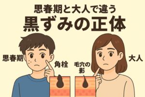「思春期と大人で違う黒ずみの正体」を説明するイラスト。 左側には思春期の男の子が鼻の黒ずみを気にしており、その下には“角栓”の皮膚断面図。 右側には大人の女性が黒ずみを気にしていて、その下には“毛穴の影”を示す皮膚断面図。 思春期は皮脂が多く角栓が黒ずみやすいのに対し、大人は毛穴の構造や影によって黒く見えることがあるという違いを視覚的に示した図。