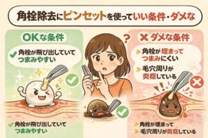 角栓除去にピンセットを使ってよい条件とダメな条件を比較した図解イラスト。角栓が飛び出していてつまみやすい場合はOK、角栓が埋まっている場合や毛穴周りに炎症がある場合はNGとして、チェックマークとバツ印で分かりやすく示されている。