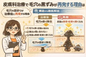 皮膚科治療後に毛穴の黒ずみが再発する理由を構造的に解説した図解イラスト。白衣の研究者が説明する横で、治療後に毛穴の詰まりを除去しても、皮脂の分泌や角質肥厚により再び詰まりが生じる流れを断面図で示している。毛穴の構造と再発メカニズムを理解するための解説ビジュアル。