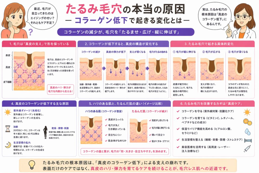 「たるみ毛穴の本当の原因 ―コラーゲン低下で起きる変化とは―」と書かれた日本語インフォグラフィック。左に悩む女性、右に白衣の女性が配置され、中央にはコラーゲンの減少によって真皮の構造が弱まり、毛穴が縦に伸びて目立つまでの過程が段階的に図解されている。下部には原因（紫外線・加齢・生活習慣など）や肌への影響、真皮ケアの重要性が整理されている。