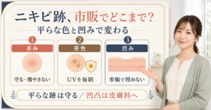 ニキビ跡の赤み・茶色・凹みを分け、市販ケアと皮膚科の境界を示すBeauty Board