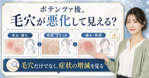 ポテンツァ 毛穴 悪化はどう考える？毛穴・皮脂・肌質の視点で整理???????
